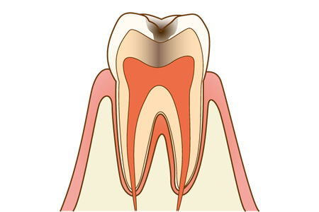虫歯のC2の特徴