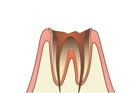 虫歯のC4の特徴