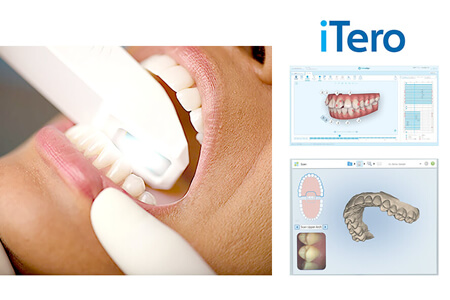 iTero 3Dによる歯並びシミレーション