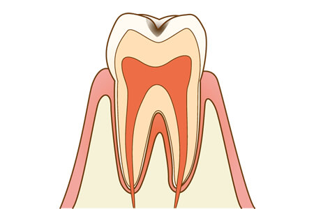 虫歯のC1の特徴