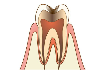 虫歯のC3の特徴