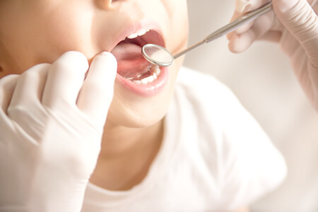 子供の虫歯の原因