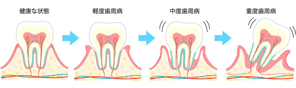 ワイズ板橋歯科・おとなこども矯正歯科の歯周病治療